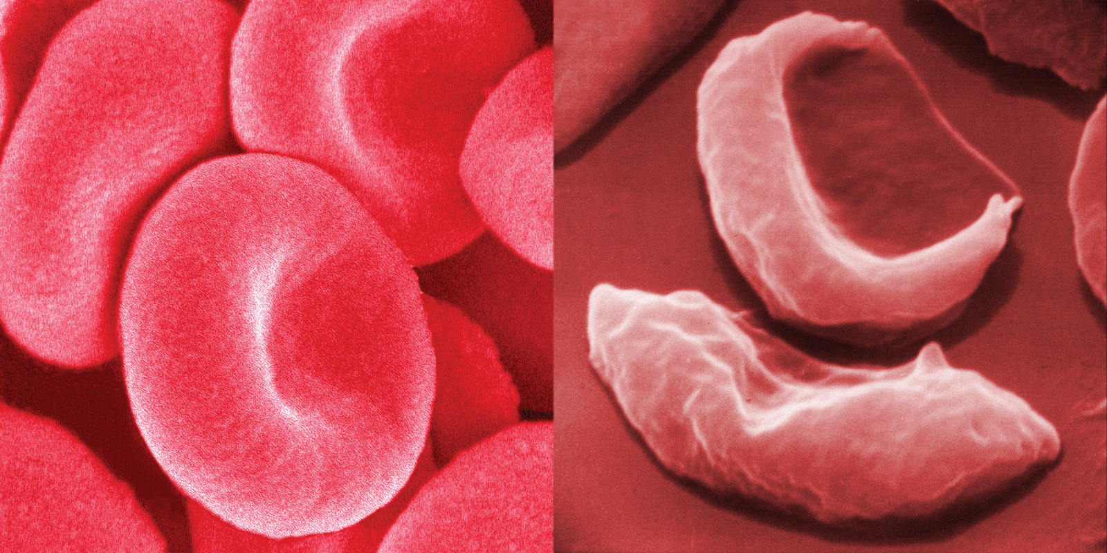 Эритроциты при серповидно клеточной анемии. Серповидноклеточная анемия кровь. Серповидно-клеточная анемия (s-гемоглобинопатия). Серповидная анемия эритроциты. Плоскоклеточная анемия.