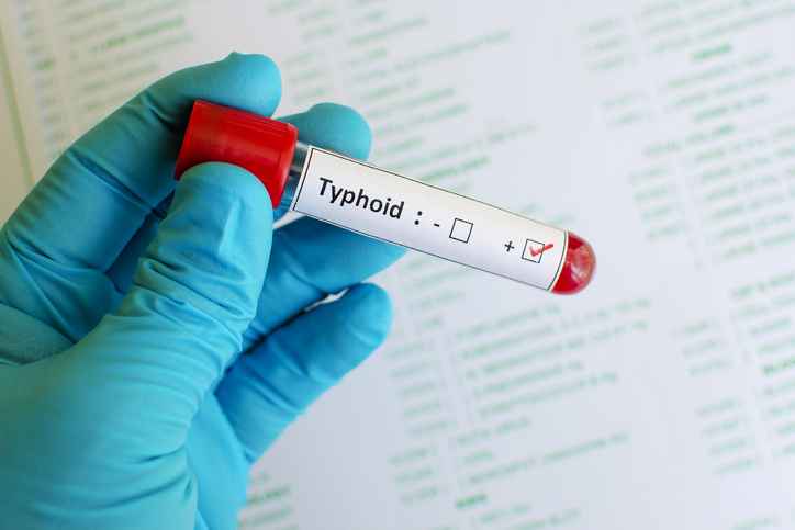 Typhoid